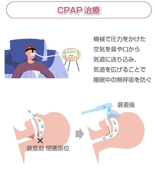 CPAP治療解説図