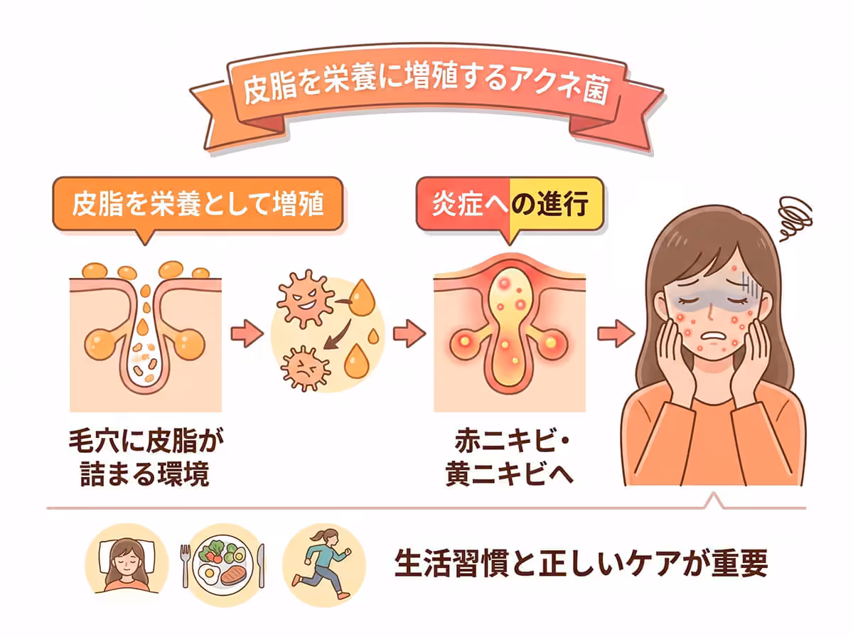 皮脂を栄養に増殖するアクネ菌