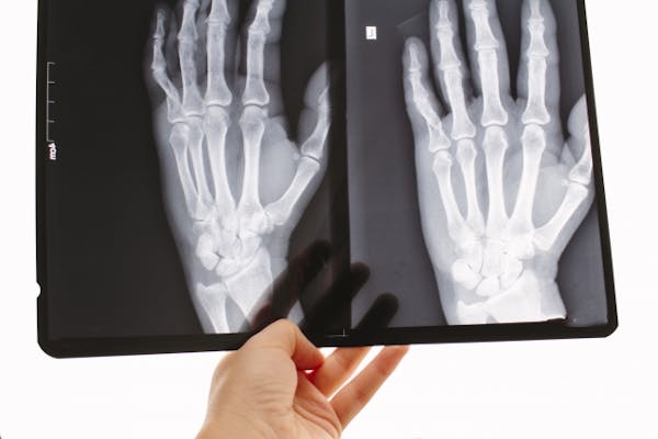 両手のレントゲン写真