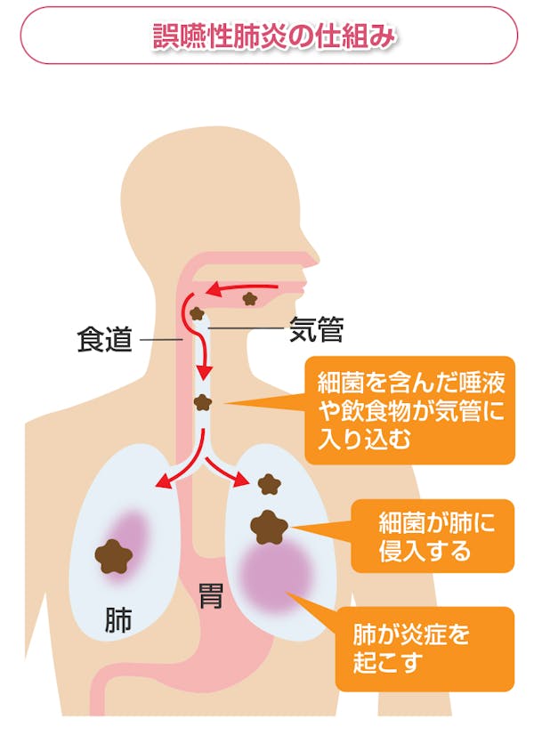 誤嚥性肺炎の予防