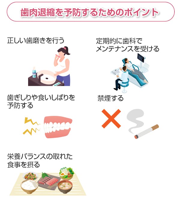 歯肉退縮を予防するためのポイント