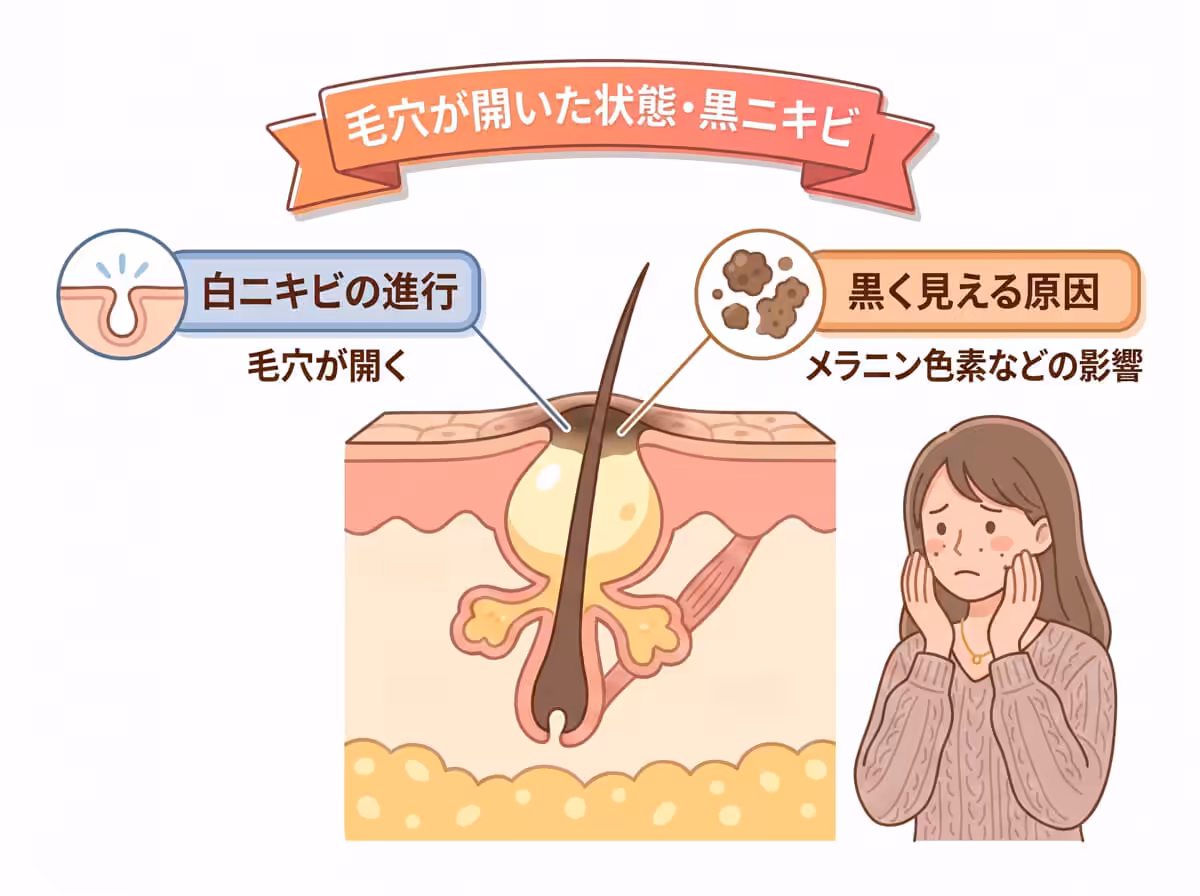 毛穴が開いた状態・黒ニキビ