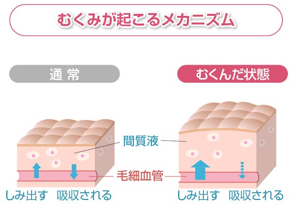 むくみが起こるメカニズム