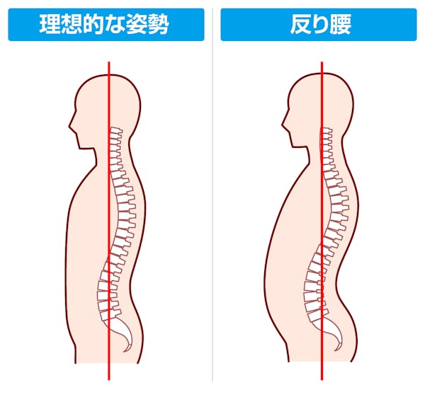 理想的な姿勢と反り腰の姿勢のイメージ