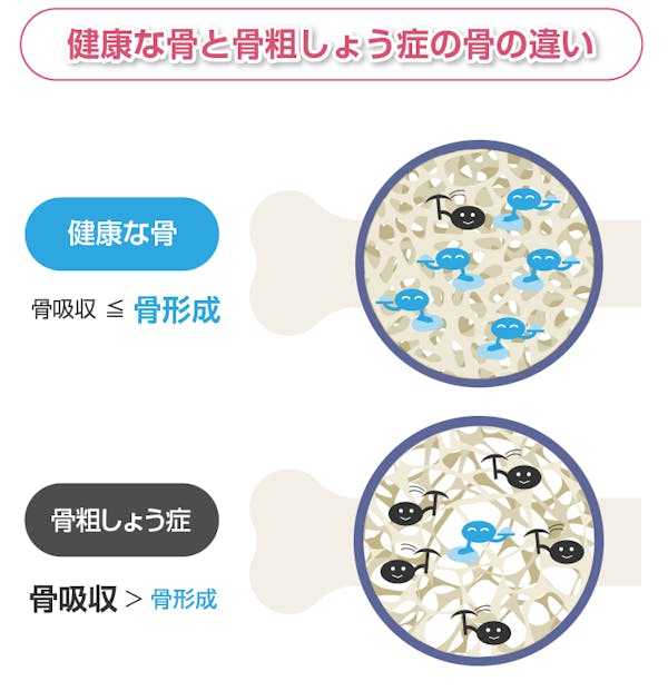 健康な骨と骨粗しょう症の骨の違い解説図