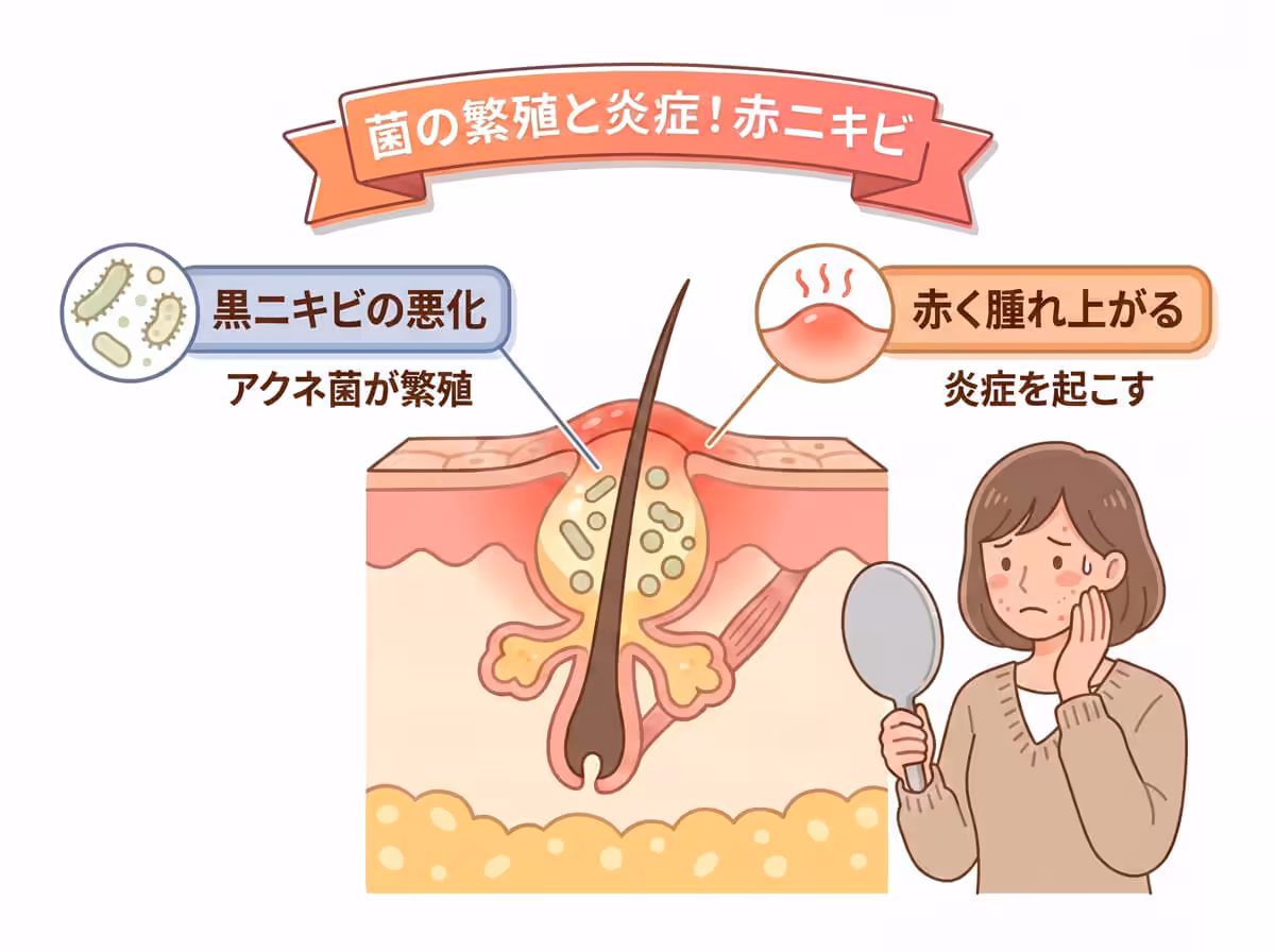菌の繁殖と炎症！赤ニキビ