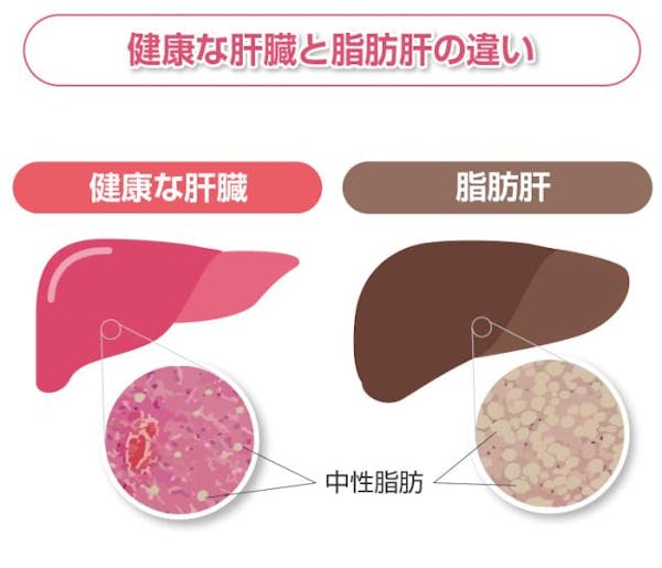 肝臓に中性脂肪がたまっている状態