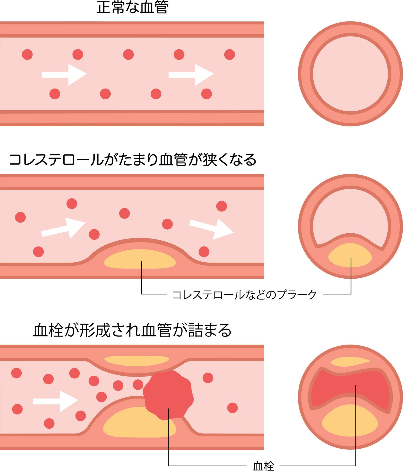 血管の状態