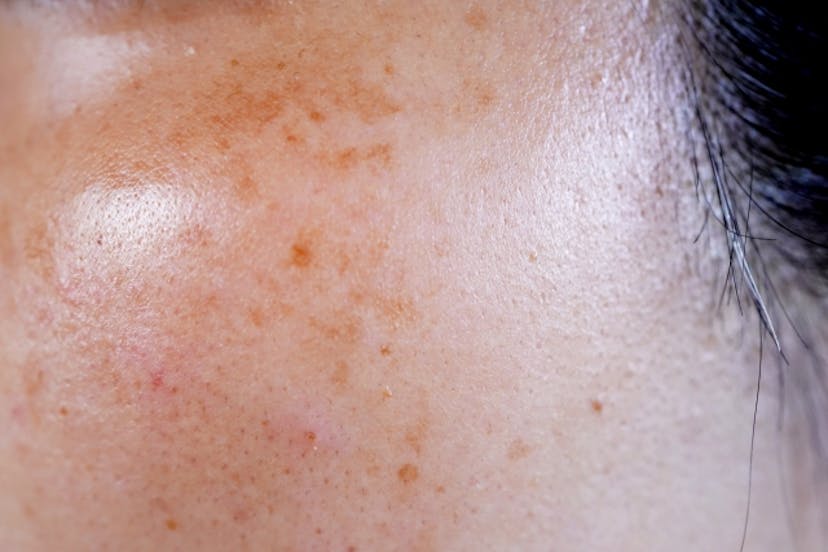 そばかすとは？原因やシミとの違い、予防法を分かりやすく解説！のサムネイル